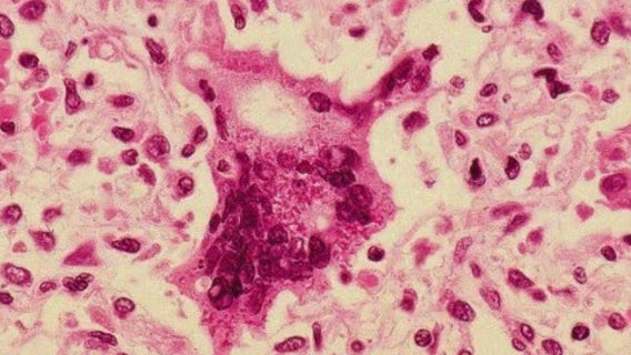 Measles case confirmed in Los Angeles at LAX - first case of 2025