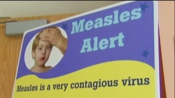 Measles in San Mateo County, 5 other California counties have confirmed cases
