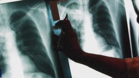 Marin County sees rise in TB cases