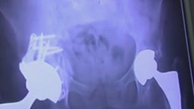 Warning signs for hip problems