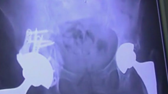 Warning signs for hip problems