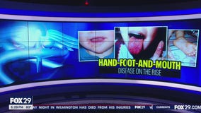 Hand, Foot, and Mouth Disease on the rise: What to know