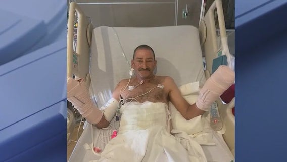 Florida man who lost most of his fingers in fireworks explosion opens up about life-changing accident