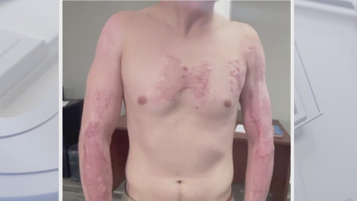 Phoenix PD faces new lawsuit from burn incident