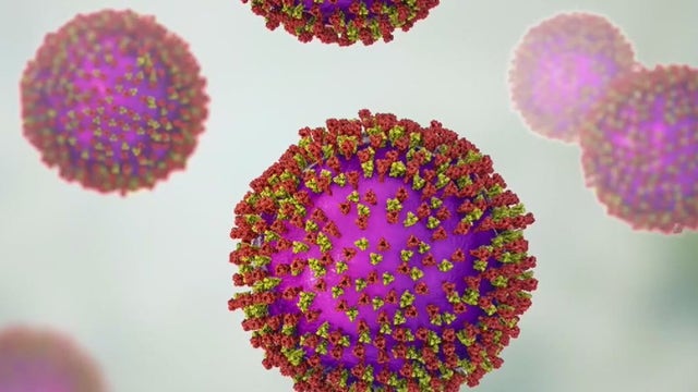 Texas measles outbreak: Spread appears to slow in West Texas