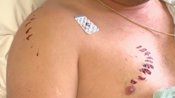 Man bitten by shark in Florida Keys while spearfishing; friend saved his life