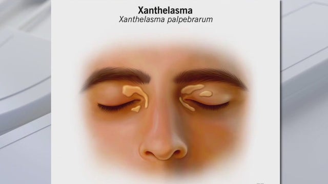 Man eating 6-9 pounds of butter and cheese a day develops ‘cholesterol hands’ while on carnivore diet: JAMA