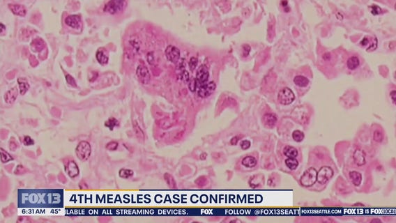 Measles case reported at Sea-Tac Airport