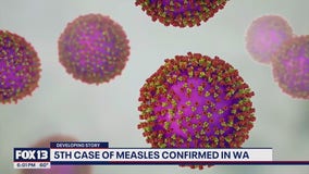 5th measles case of 2025 confirmed in WA