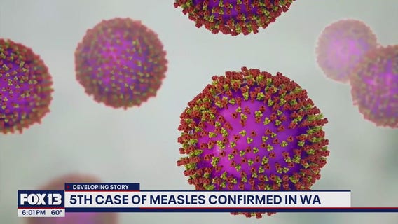 5th measles case of 2025 confirmed in WA