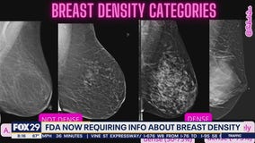 FDA now requiring information about breast density