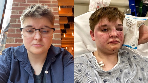 Victim of alleged homophobic attack in Carpentersville speaks out