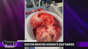 Exclusive: Doctor removes woman's 20lbs tumors, saving her from hysterectomy