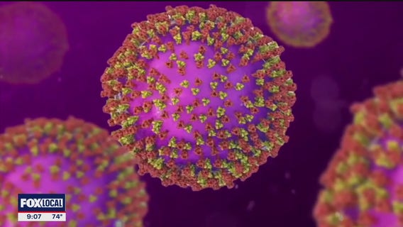 Denton County first measles case of 2025