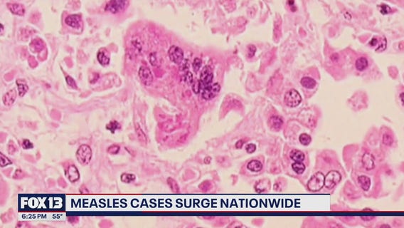 Push for vaccinations as measles cases surge