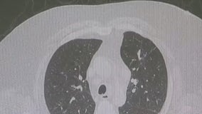 Lung cancer survival rates are improving