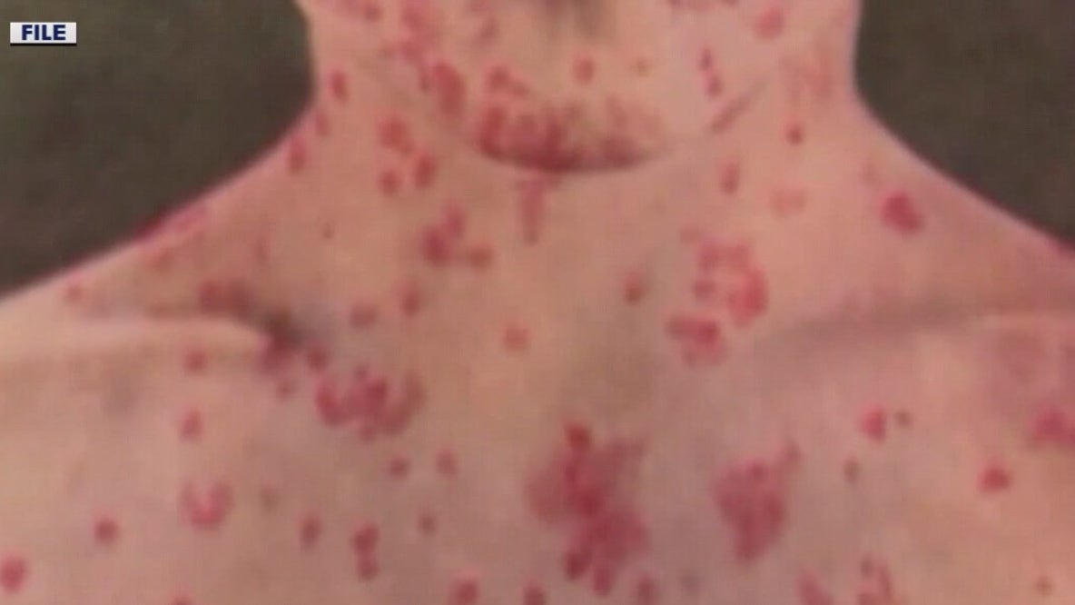 Unvaccinated child dies from measles