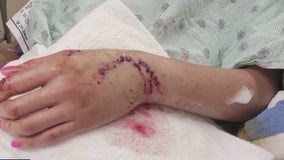 19-year-old recovers from shark bite in Galveston