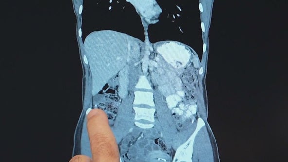 Saving fertility during cancer: One woman’s journey and the procedure helping others
