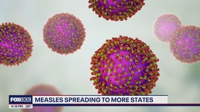 Measles outbreak spreading to more states