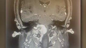 Houston woman sues Pfizer, claims birth control shot caused brain tumor