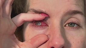 How to prevent contact lenses infections