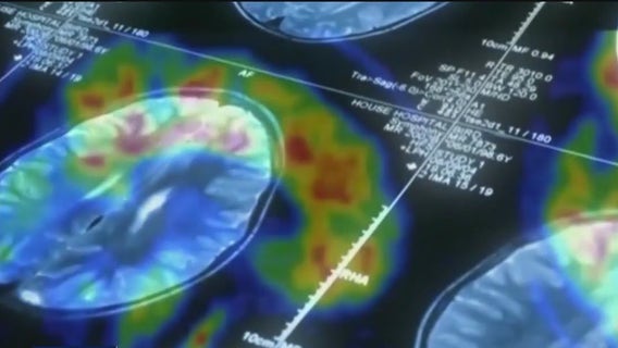 Emory researchers develop promising blood test to detect Alzheimer’s early