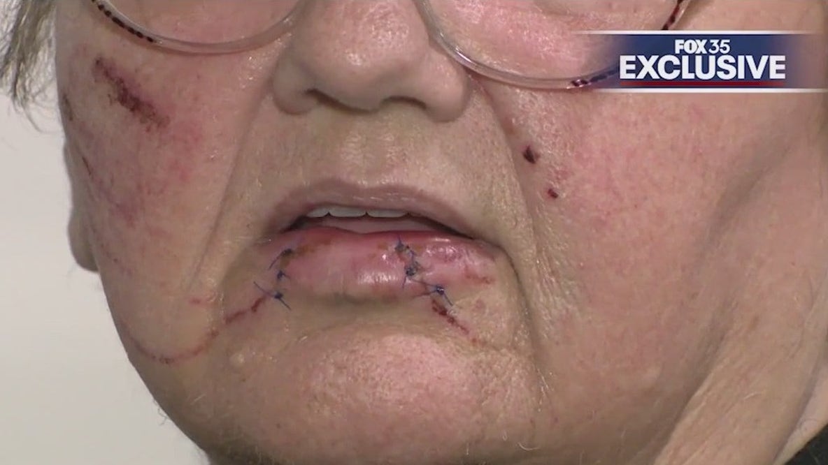 Woman bitten by dog while feeding homeless