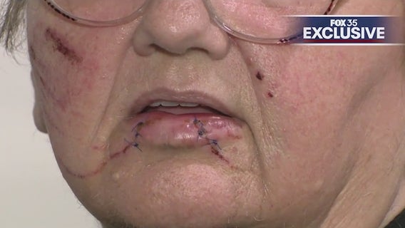 Ocala woman bitten by dog while feeding homeless, vows to continue mission