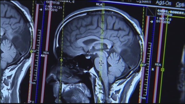 Northwestern Medicine achieves breakthrough in brain cancer treatment