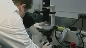 Study finds possible cause, cure for Lupus