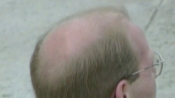Can onion juice stop hair loss?