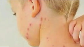 LI officials warn of potential measles exposures
