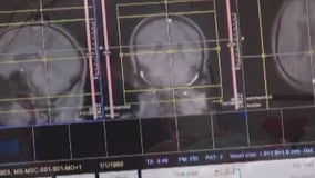 UCSF creates 'brain pacemaker' to treat Parkinson's disease