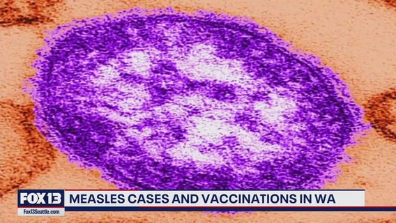 WA lagging behind in measles vaccinations