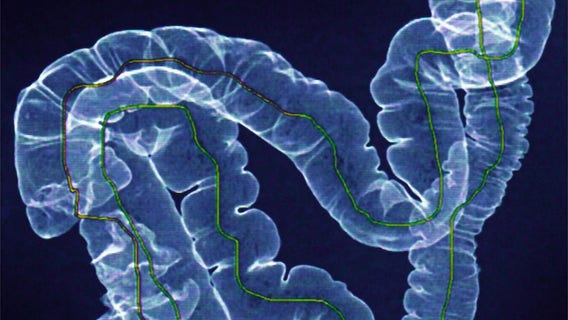 Terminal colon cancer patient saved by breakthrough treatment