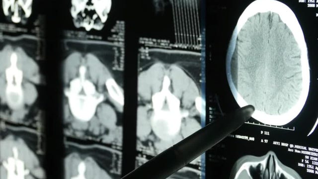 Too much sitting increases Alzheimer’s risk, even if you exercise regularly, study finds