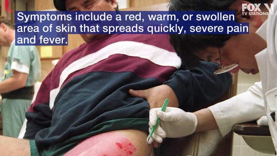 East Coast, Gulf states warn of rising flesh-eating bacteria infections