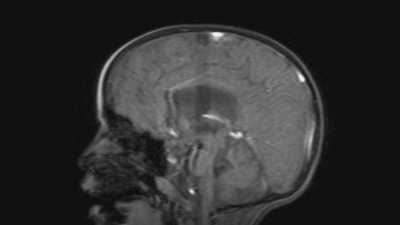 Donated brain thrown out; lawsuit dismissed