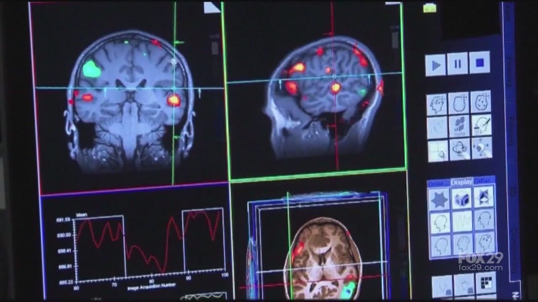 Working to find a cure for Alzheimer's Disease | FOX 29 News Special