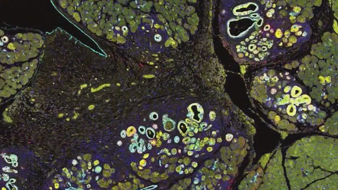 Pancreatic cancers vaccine showing promise