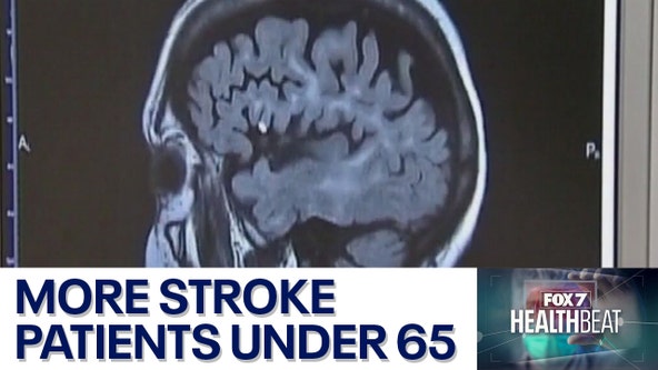 Doctors seeing younger stroke patients