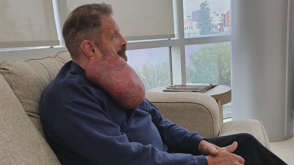 Scottsdale man has giant tumor removed from face