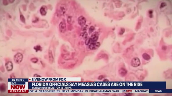 Florida measles cases on the rise