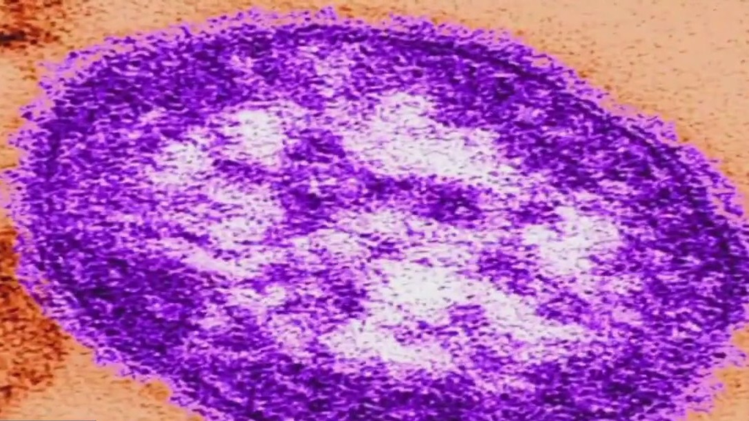 What we know about measles outbreak