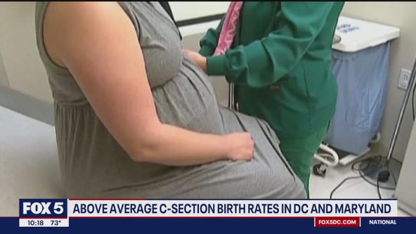 C-section birth rates above average in DC, Maryland