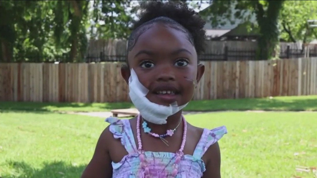 Austin 4-year-old attacked by dog