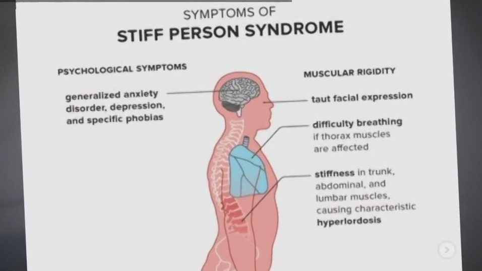 What is 'stiff-person syndrome''?