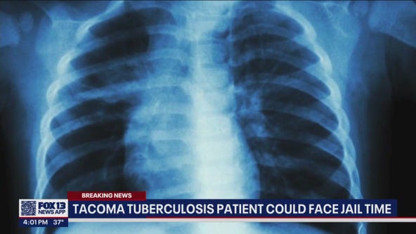 Woman with tuberculosis in Tacoma refusing treatment, could face jail time