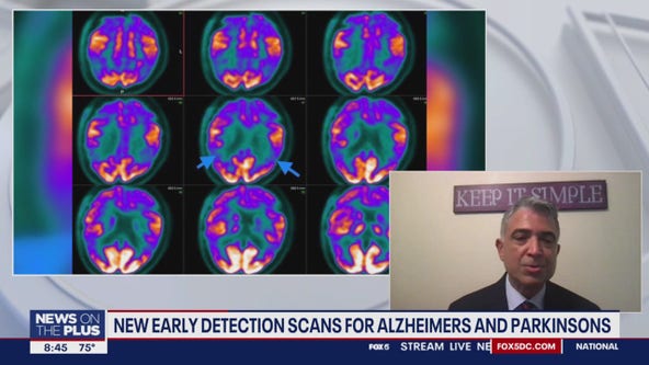New early detection scans for Alzheimer's and Parkinson's